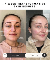 Elite LED Face Mask