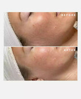 Dermaplaning Blades