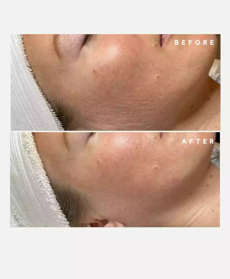 Dermaplaning Blades