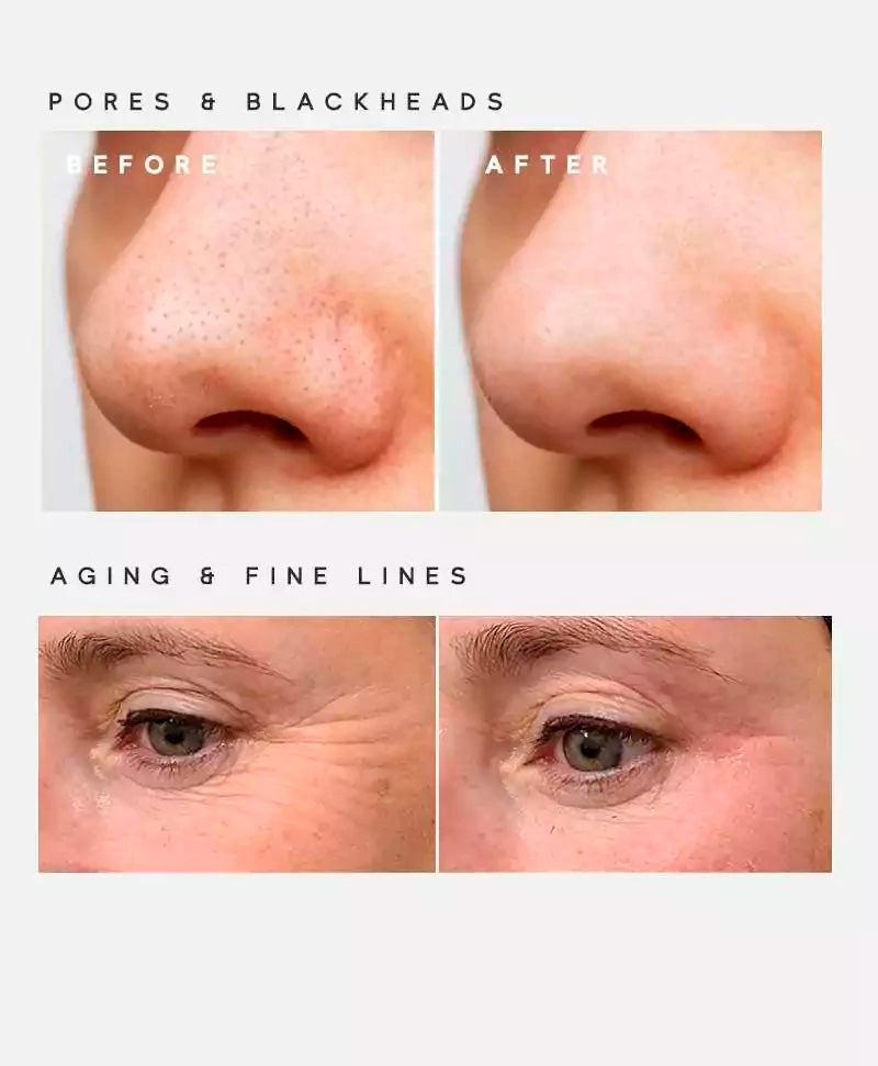 Microdermabrasion Exfoliating Heads